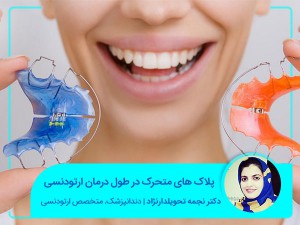 لويحات قابلة للإزالة أثناء علاج تقويم الأسنان